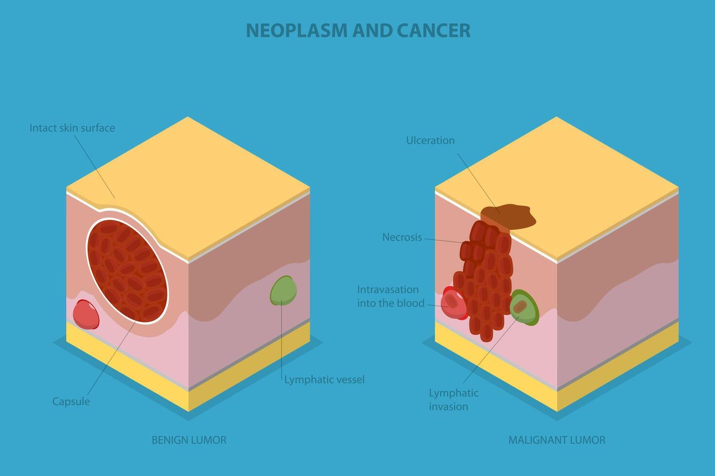 3D Isometric Flat Conceptual Illustration of Neoplasm And Cancer, Tumor Development vector