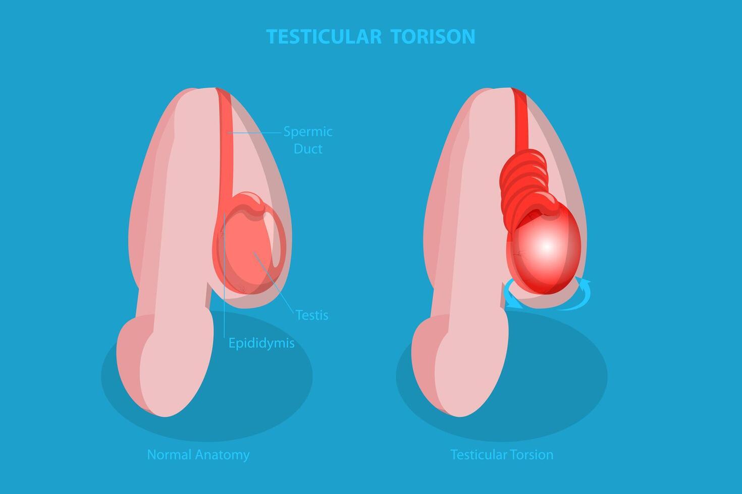 3D Isometric Flat Conceptual Illustration of Testicular Torison, Male Reproductive System Disorder vector