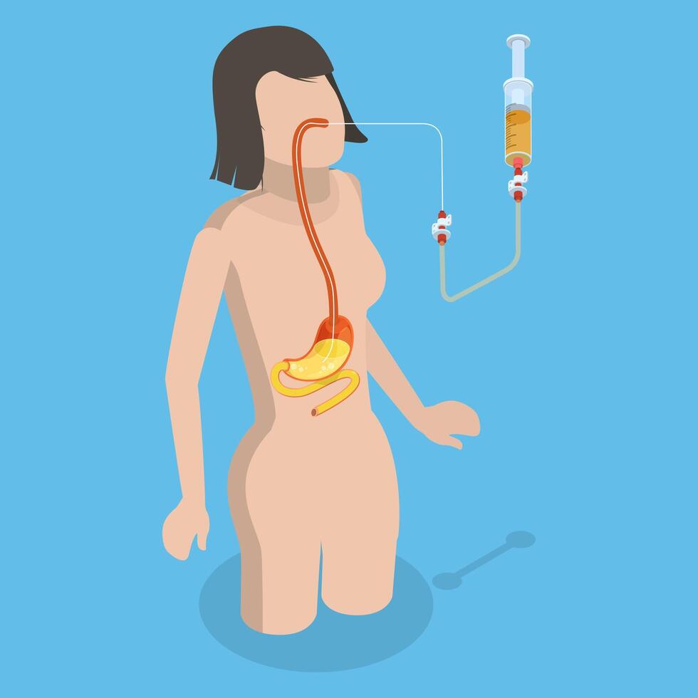 3D Isometric Flat Conceptual Illustration of PEG, Nasogastric Tube Passed Through the Nose to Stomach vector