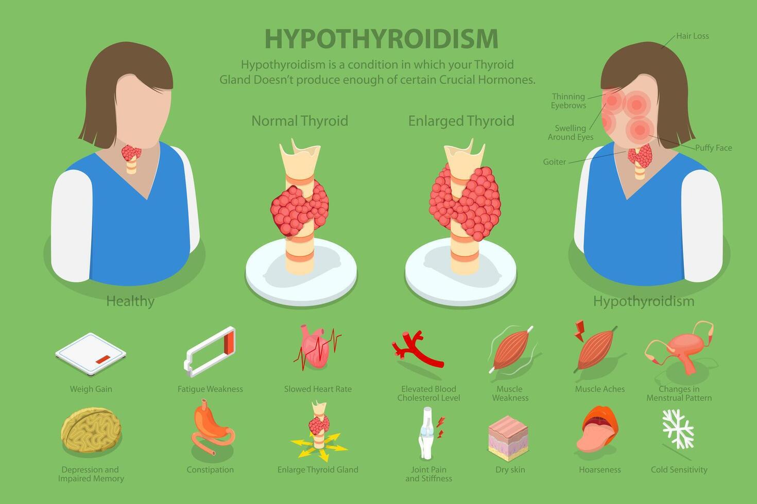 3D Isometric Flat Conceptual Illustration of Hypothyroidism, Thyroid Gland Disease vector