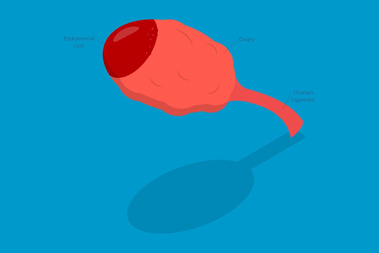 3D Isometric Flat Conceptual Illustration of Endometrioma, Ovarian Cyst vector