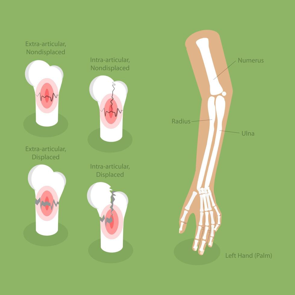 3D Isometric Flat Conceptual Illustration of Distal Radius Fracture, Labeled Educational Diagram vector