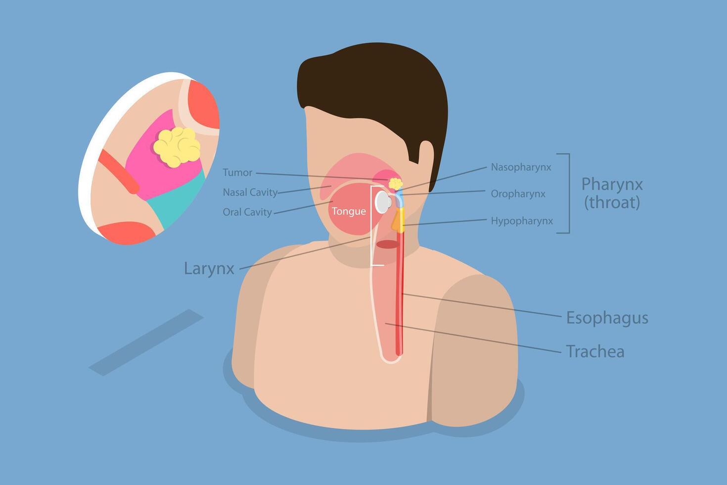 3D Isometric Flat Conceptual Illustration of Nasopharyngeal Carcinoma Tumor, Educational Diagram vector