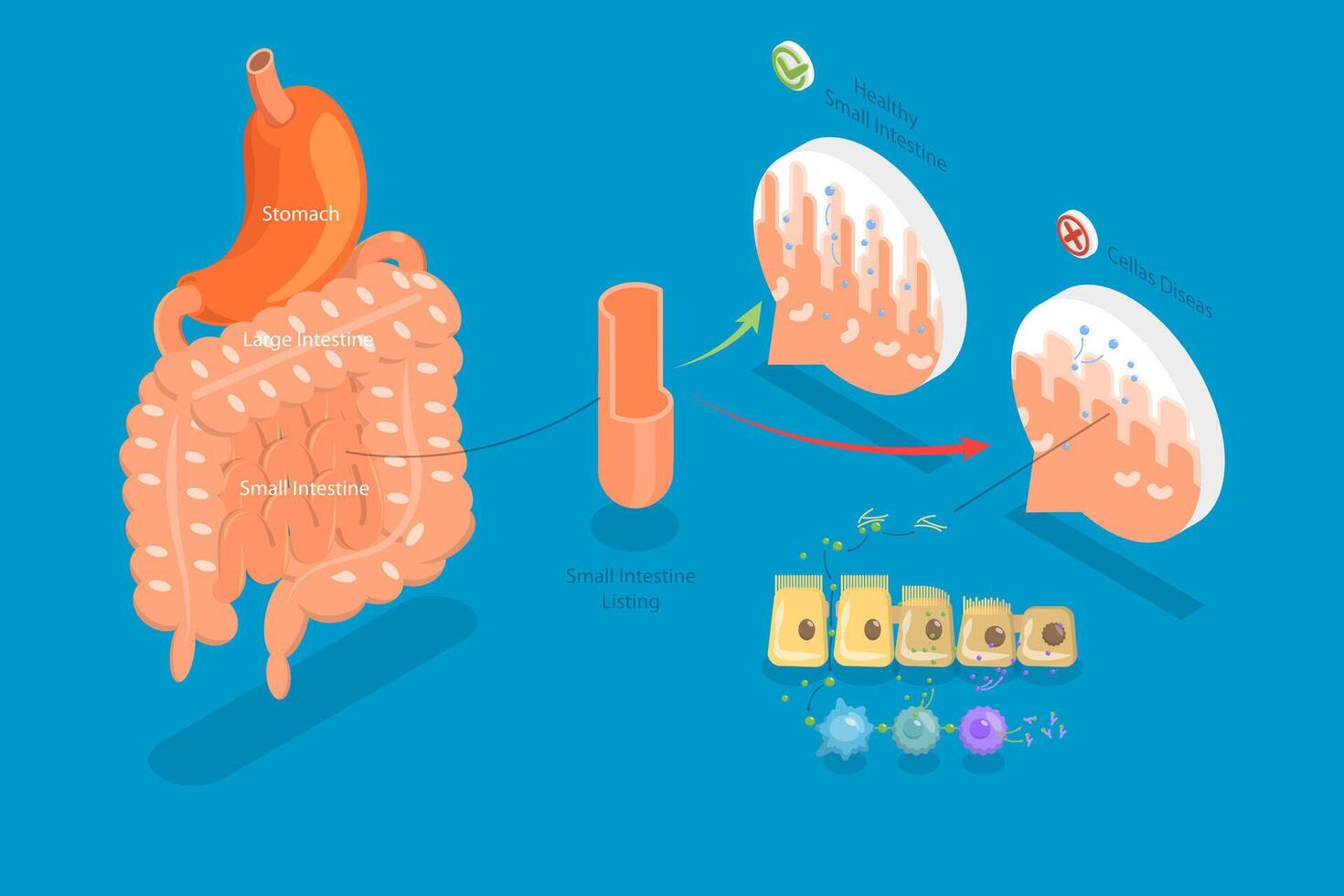 3D Isometric Flat Conceptual Illustration of Celiac Disease, Educational Diagram vector
