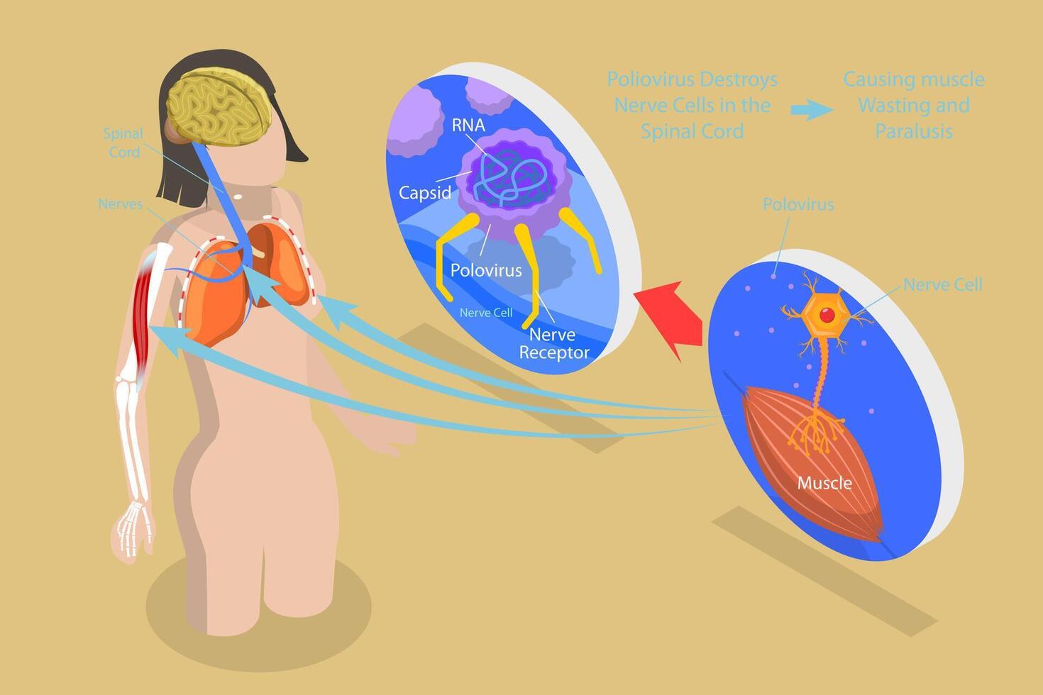 3D Isometric Flat Conceptual Illustration of Poliomyelitis, Labeled Medical Virus Infection Symptoms Explanation scheme vector