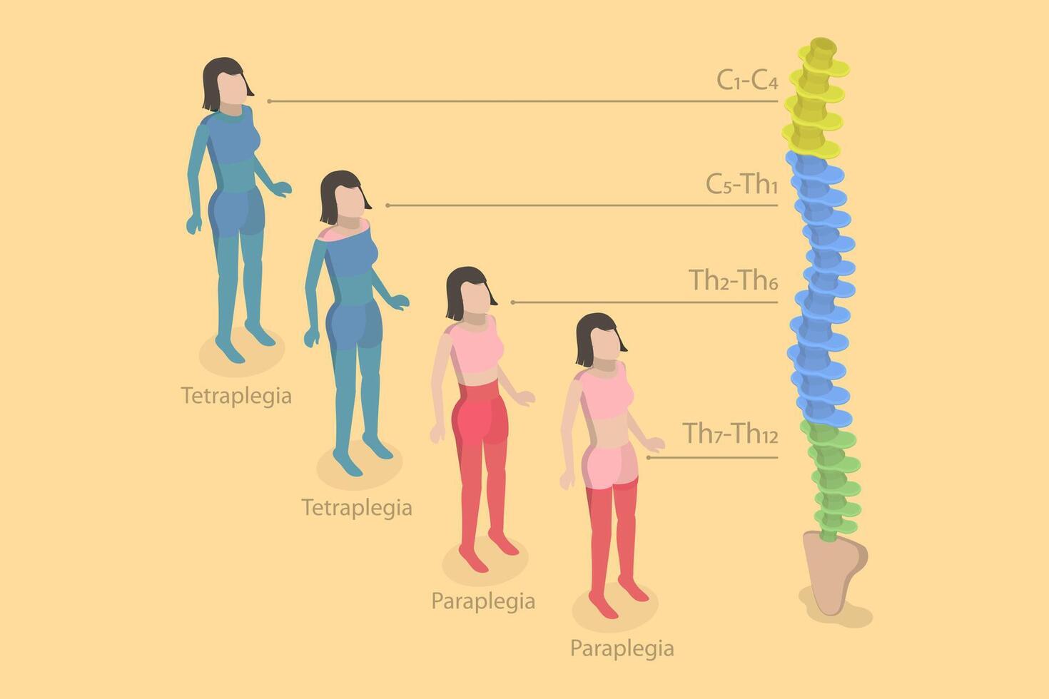 3D Isometric Flat Conceptual Illustration of Tetraplegia And Paraplegia , Neural Medical Disorder vector