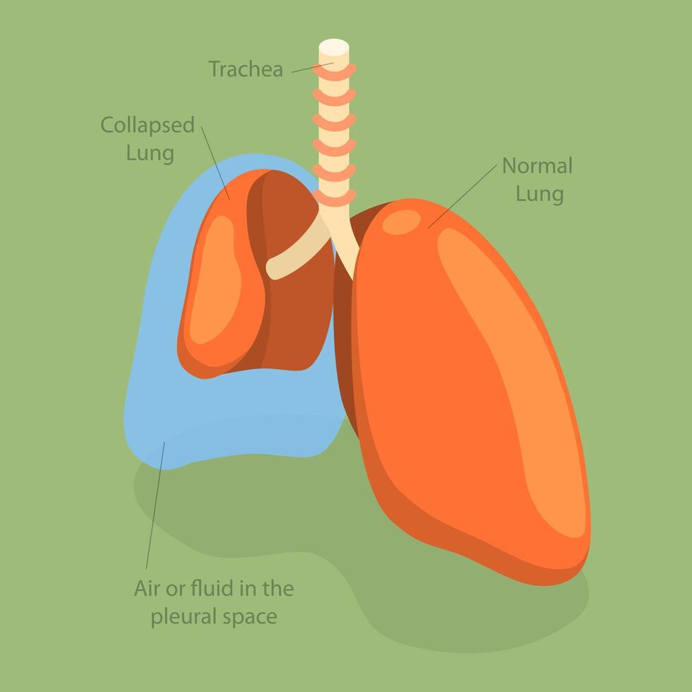 3D Isometric Flat Conceptual Illustration of Collapsed Lung, Respiratory System Issue vector