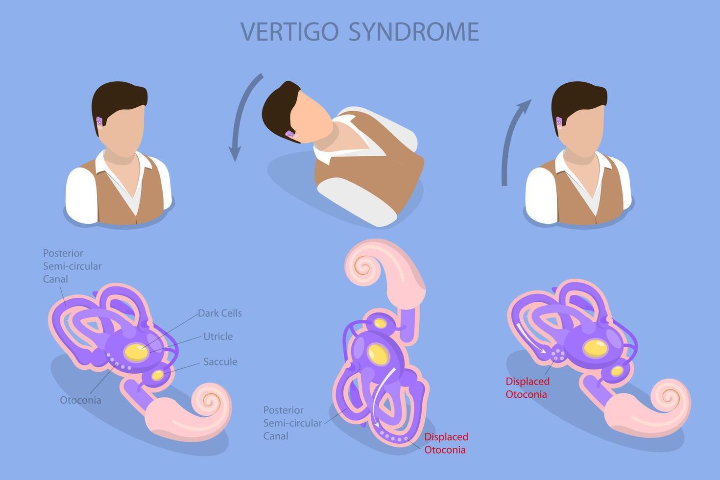Symptoms and causes of vertigo syndrome vector