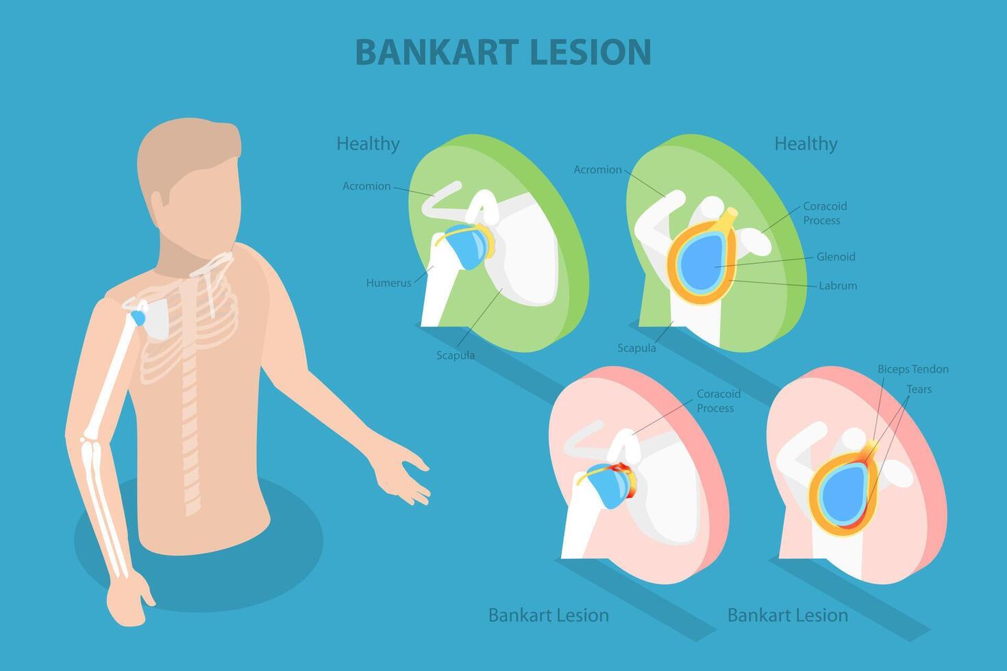 Illustration of Bankart Lesion anatomy vector