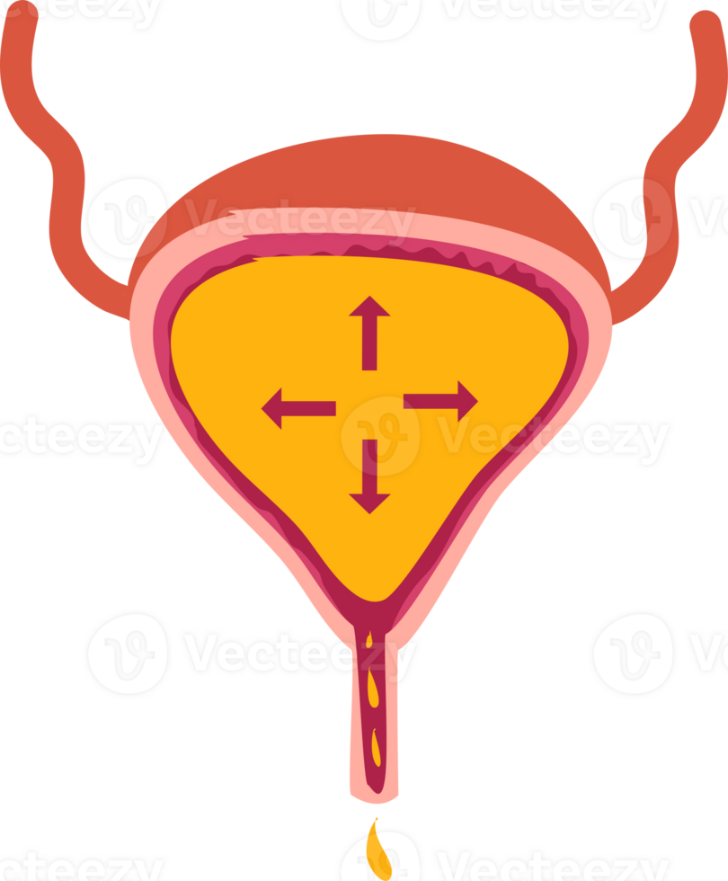 Overflow urinary incontinence illustration png