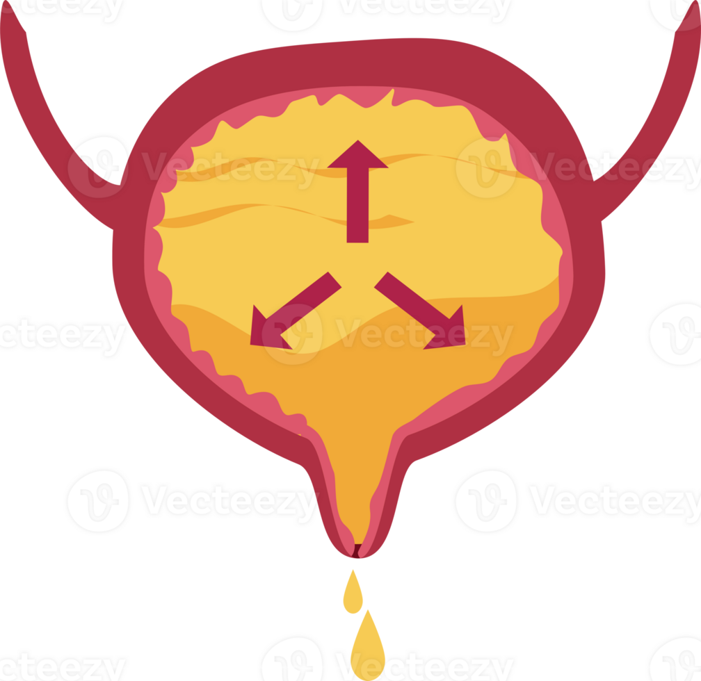 Overflow incontinence illustration png