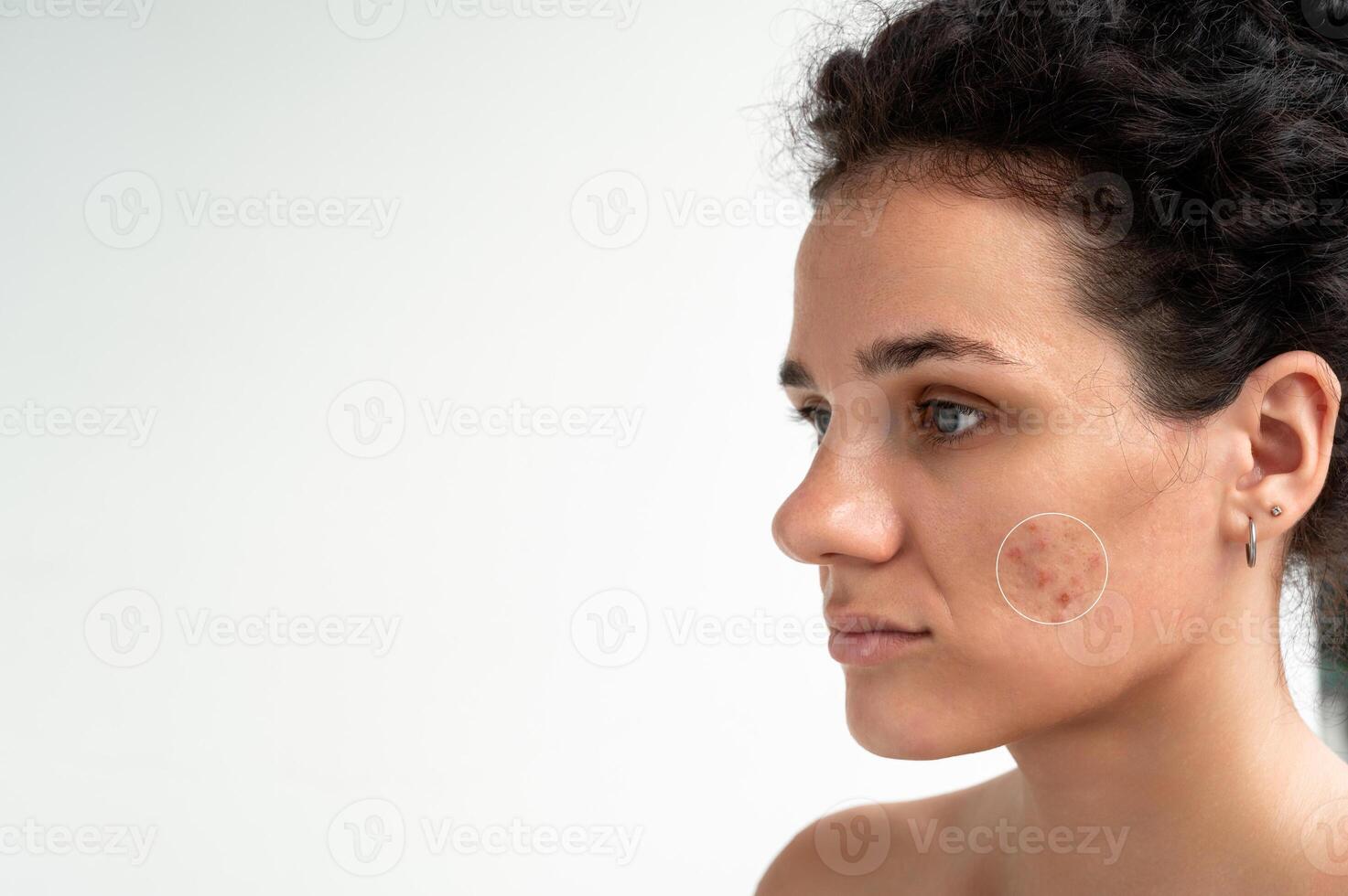 Close-up of a young girl with skin problems. Pimples, acne, pores, scars. Natural skin with and without filters photo