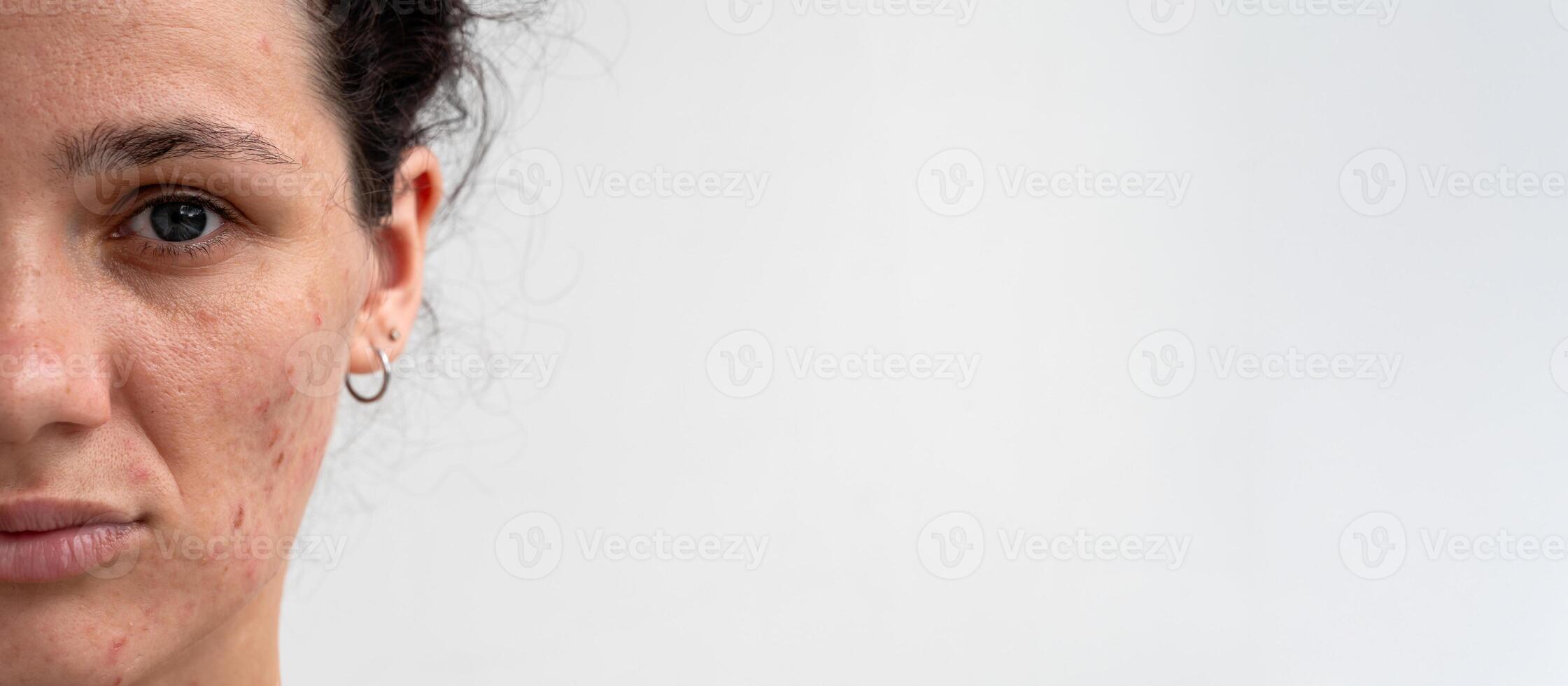 Close-up portrait of a young Caucasian woman with skin problems - pimples, acne, enlarged pores. A place for your text photo