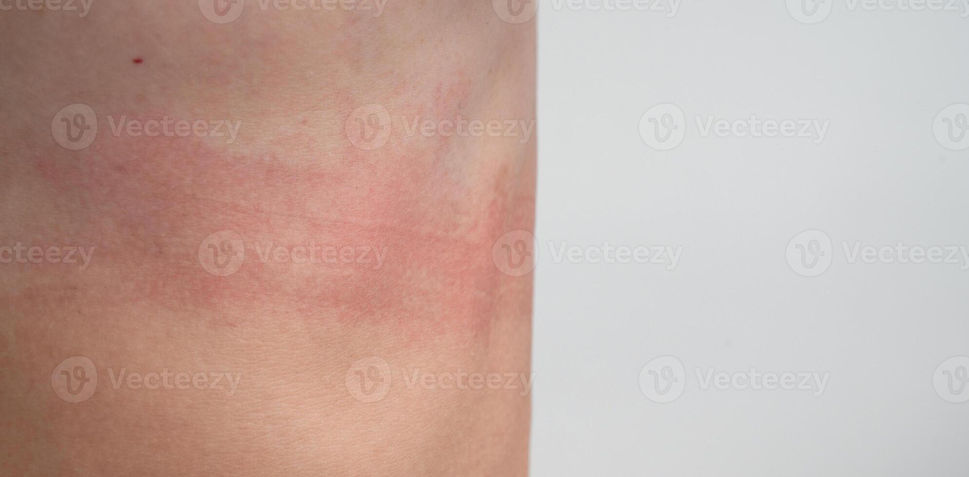 Panoramic view of the bra marks on the female body. An uncomfortable bra. Traces of clothing on the body. photo