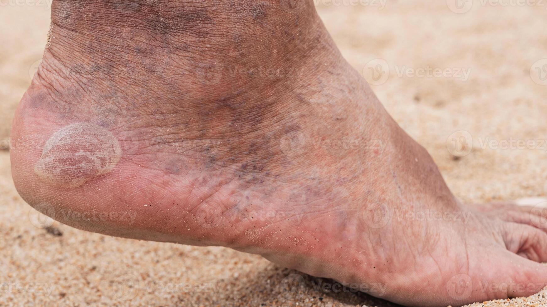 Bare male feet with a callus on the heel and venous dilatation of veins photo