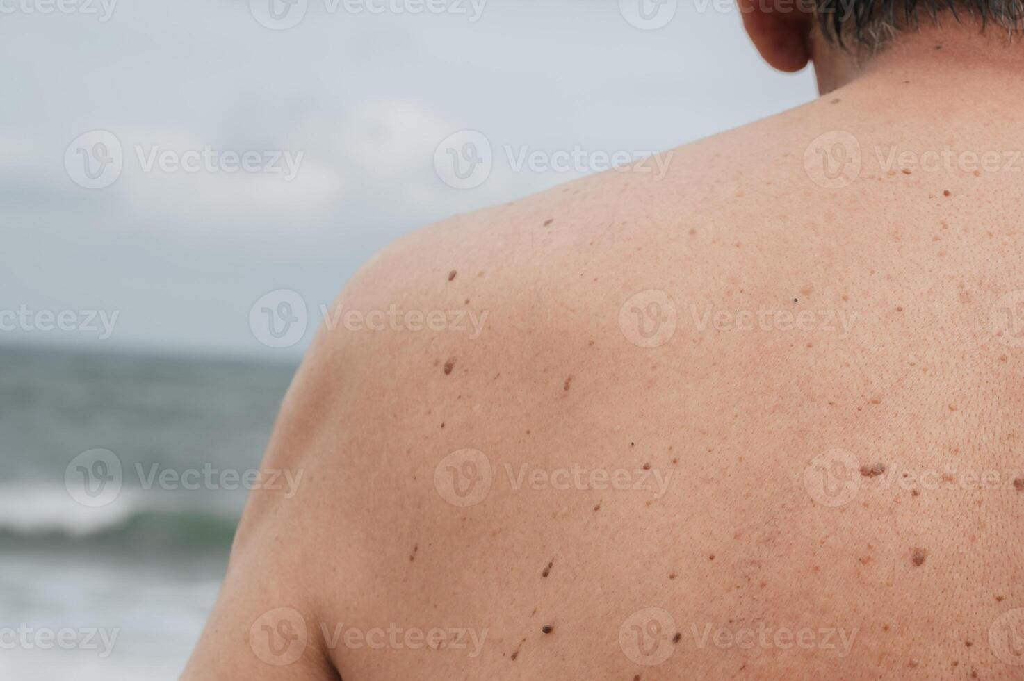The back of an elderly man with freckles, aging spots, black, brown warts and wrinkles photo