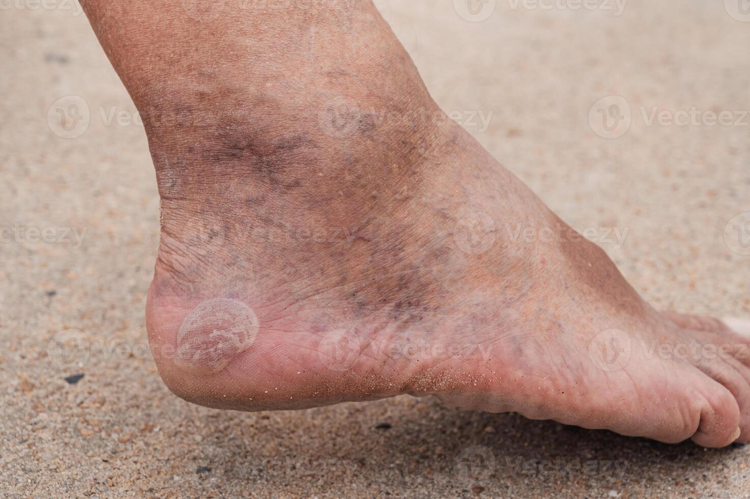 Bare male feet with a large callus on the heel and venous dilatation of veins photo