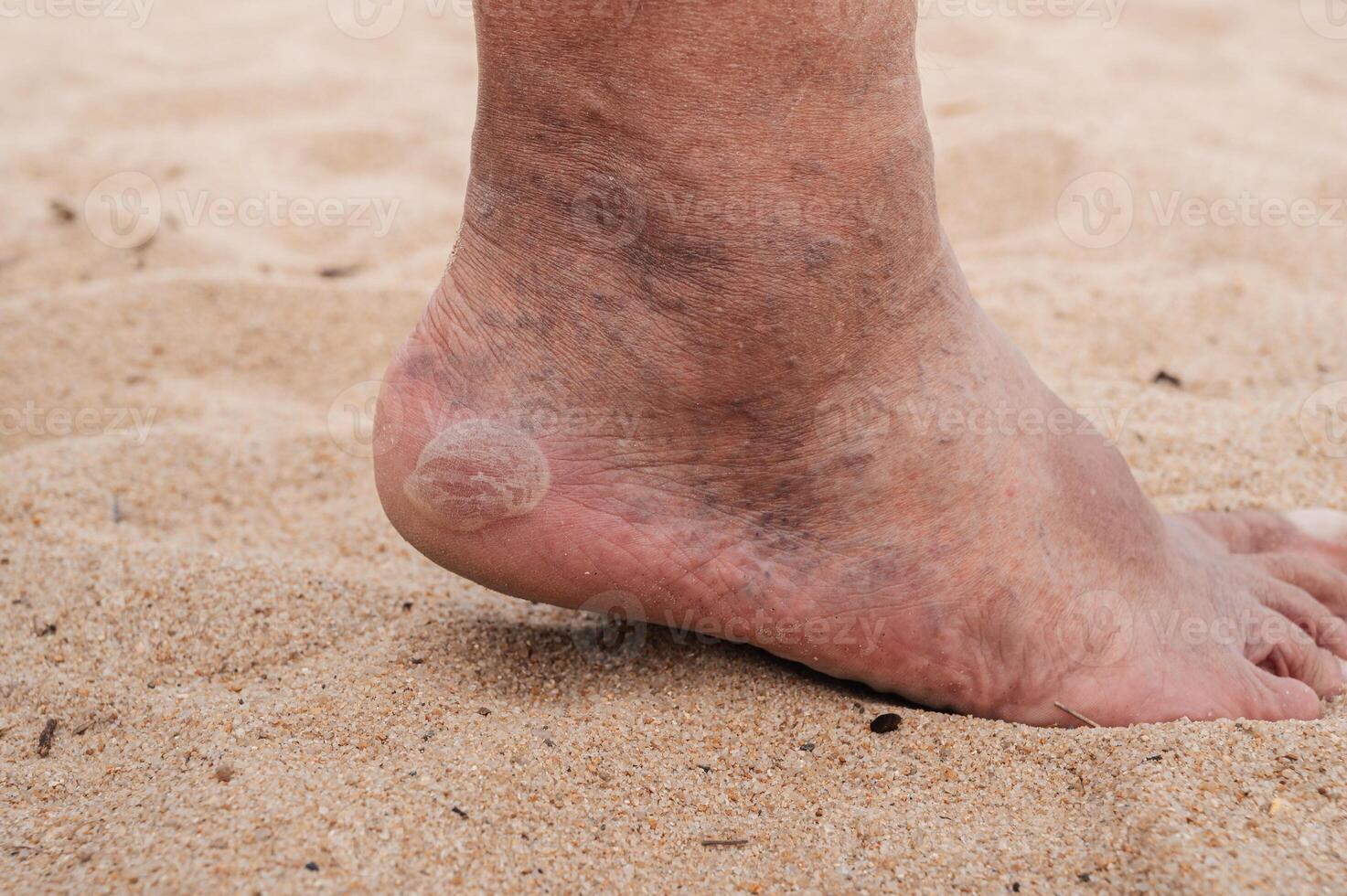 Bare male feet with a large callus on the heel and venous dilatation of veins. photo