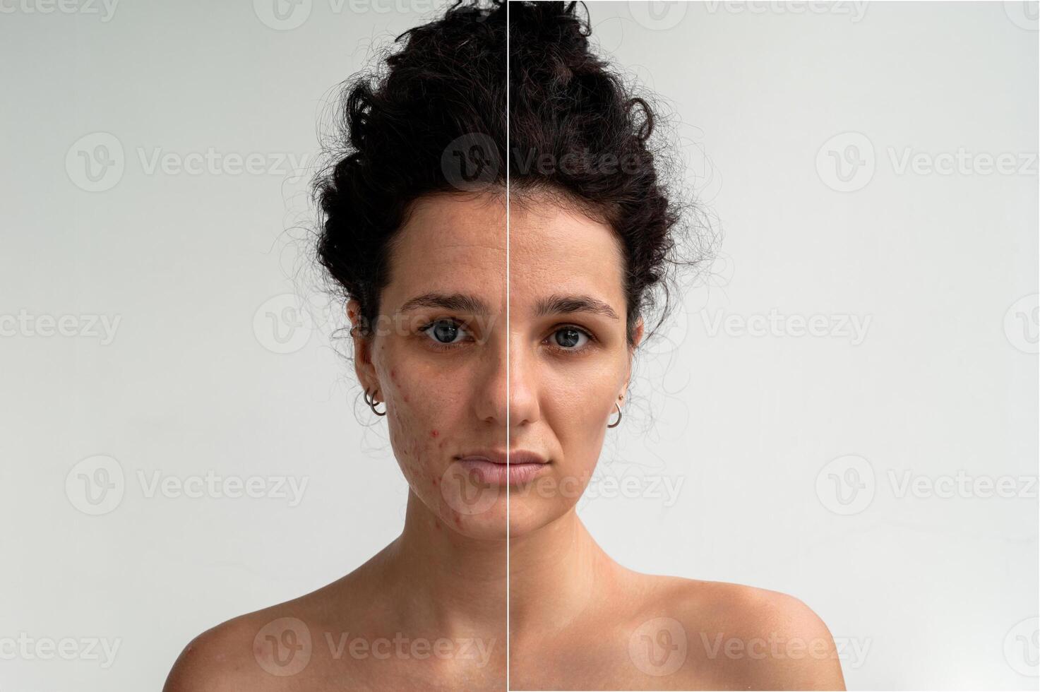 A shot of the face and body of a young woman with skin problems - pimples, acne, enlarged pores. with and without filter. photo