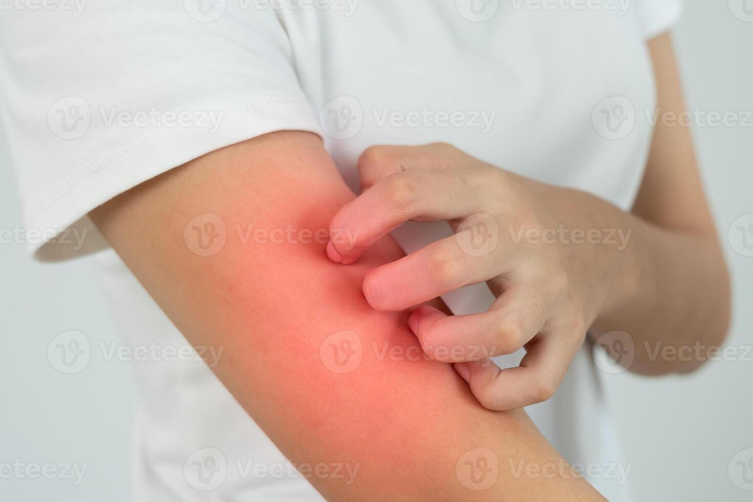 skin problem and beauty, woman scratch body has itchy skin from skin allergic, steroid allergy, sensitive skin, red from sunburn, chemical allergy, rash, insect bites, Seborrheic Dermatitis, photo