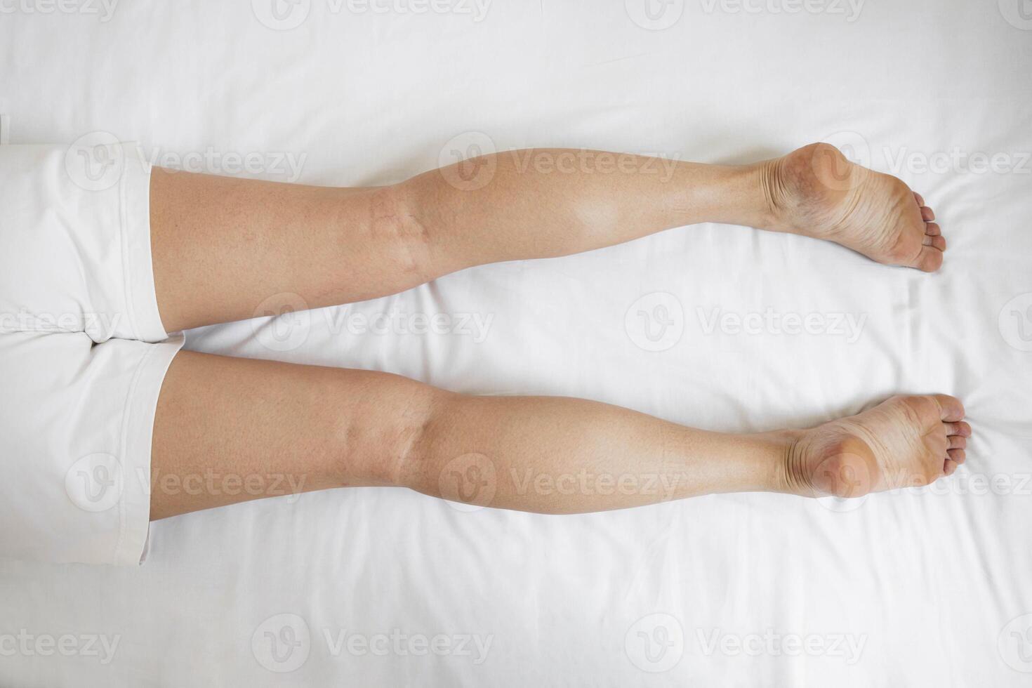 top view of adult woman legs on medical bed, visible signs of leg swelling, skin changes, concept of chronic venous insufficiency, lymphedema, post-surgical recovery, diagnostic evaluation photo