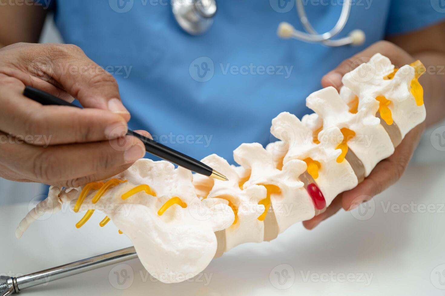 doctor holding spinal nerve and bone model, Lumbar spine displaced herniated disc fragment in hospital photo