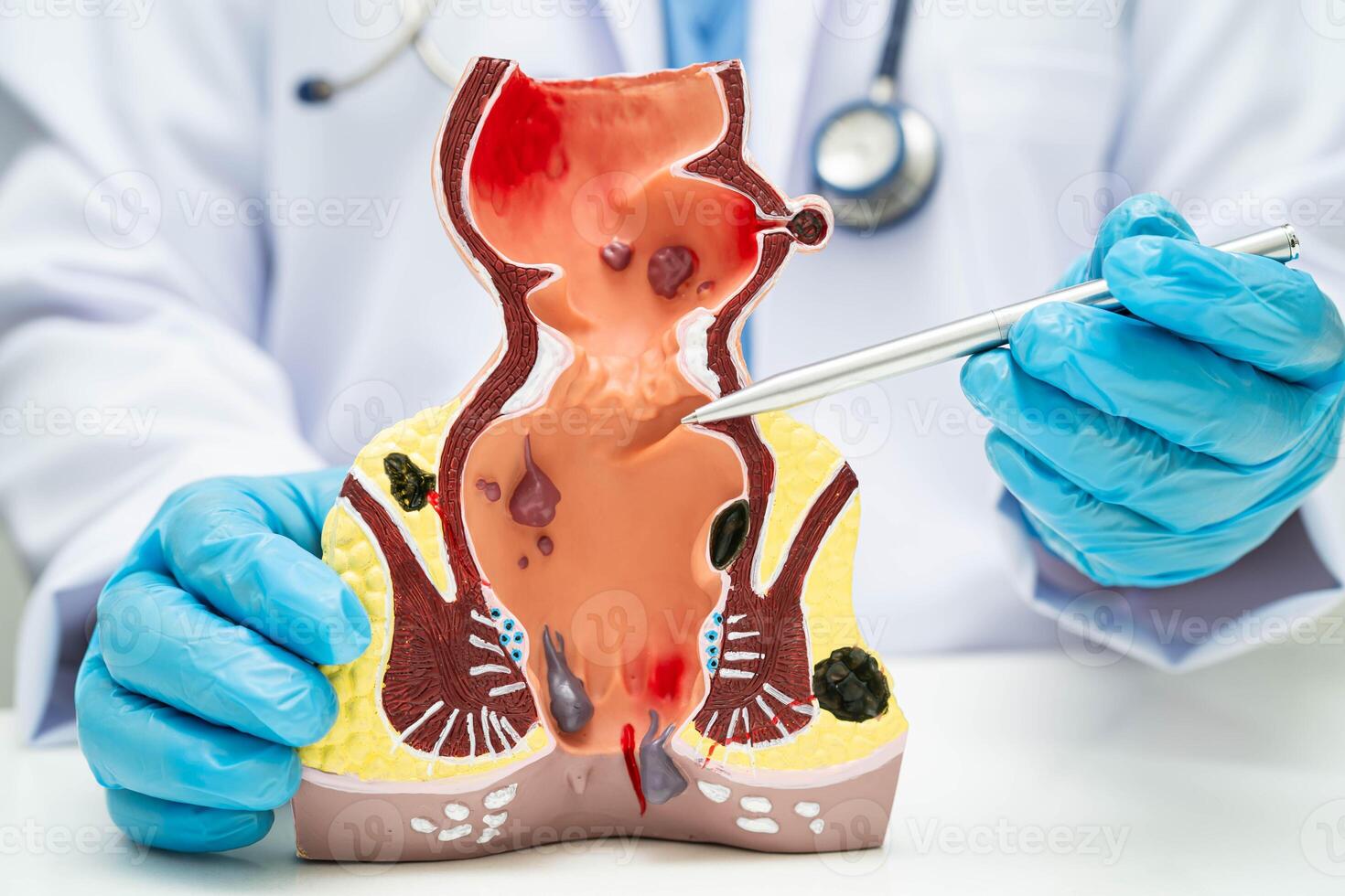 doctor rectum and hemorrhoid human anatomy model at hospital, inflamed vascular structure. photo