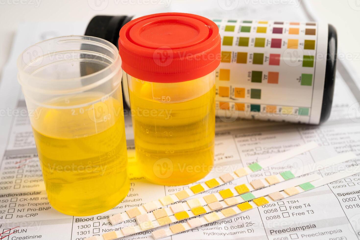 Urinalysis urine cup with reagent strip pH paper test and comparison photo