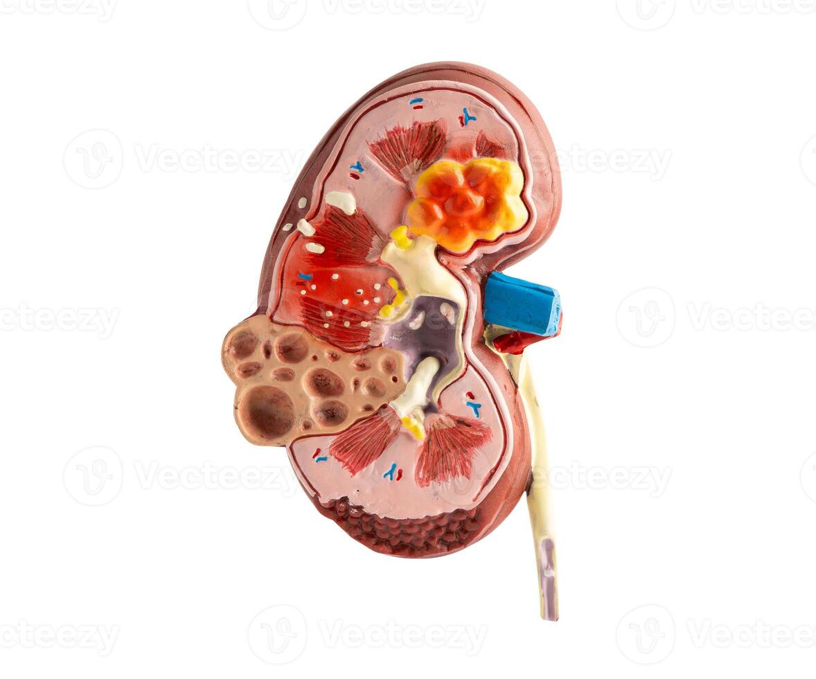 Kidney model isolated on white background with clipping path. Chronic kidney disease, treatment urinary system, urology, Estimated glomerular filtration rate eGFR. photo