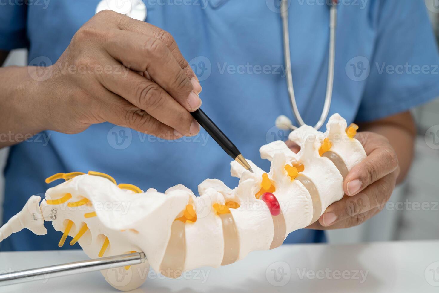 doctor holding spinal nerve and bone model, Lumbar spine displaced herniated disc fragment for treatment medical in the orthopedic department. photo