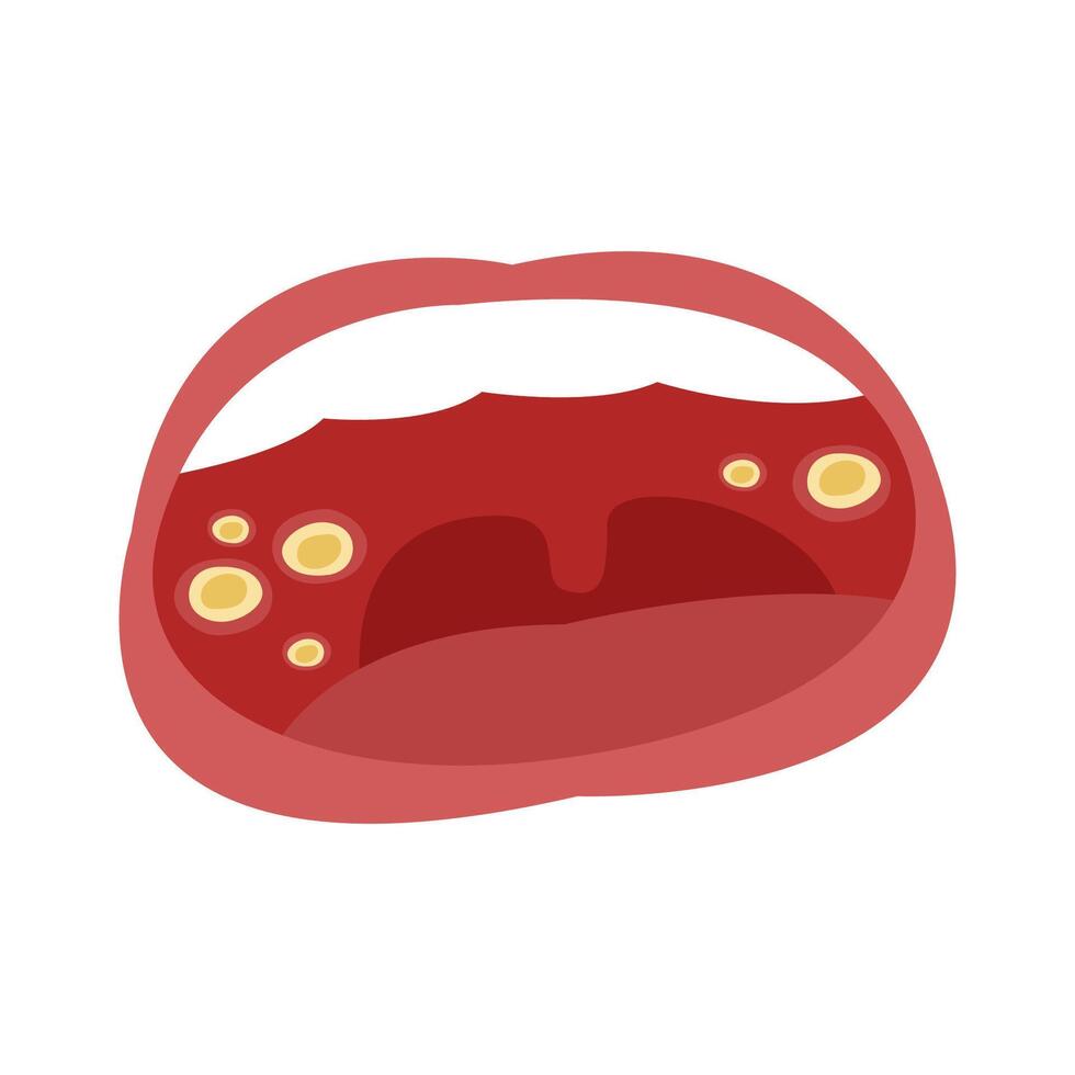 canker sore in mouth. illustration vector