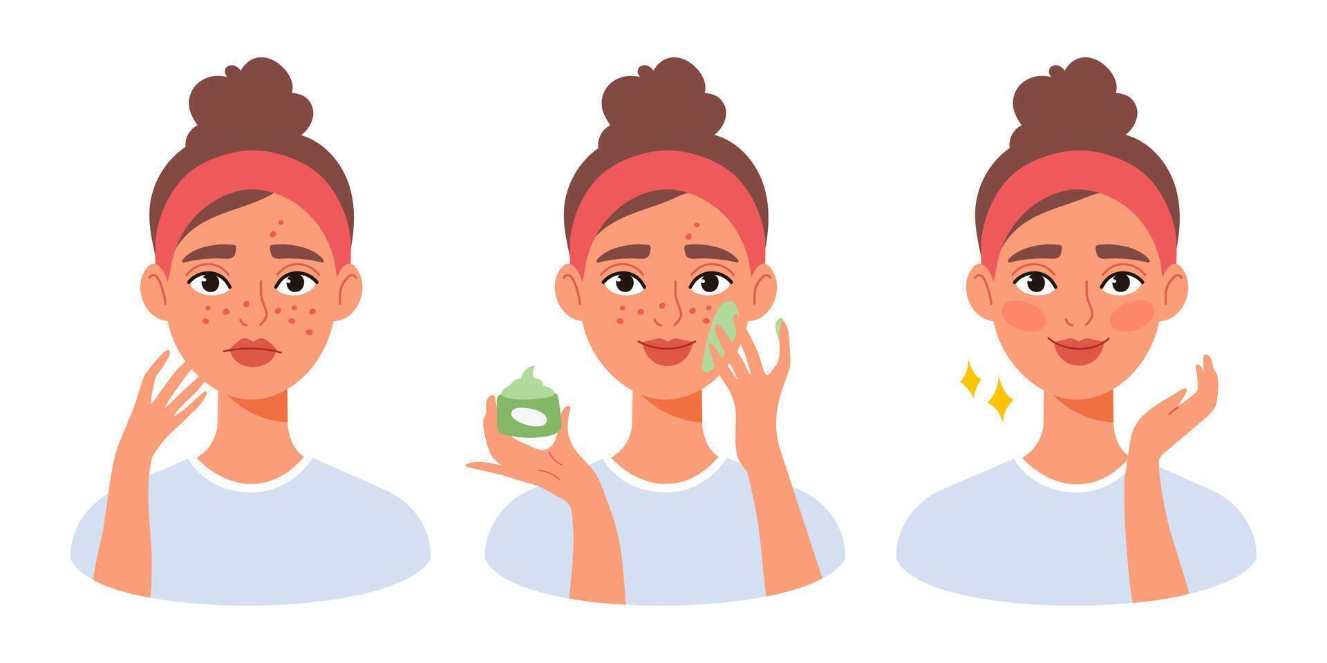 Young woman with acne applying cream and achieving clear glowing skin. Skincare routine concept, step-by-step transformation with facial treatment and cosmetic care vector