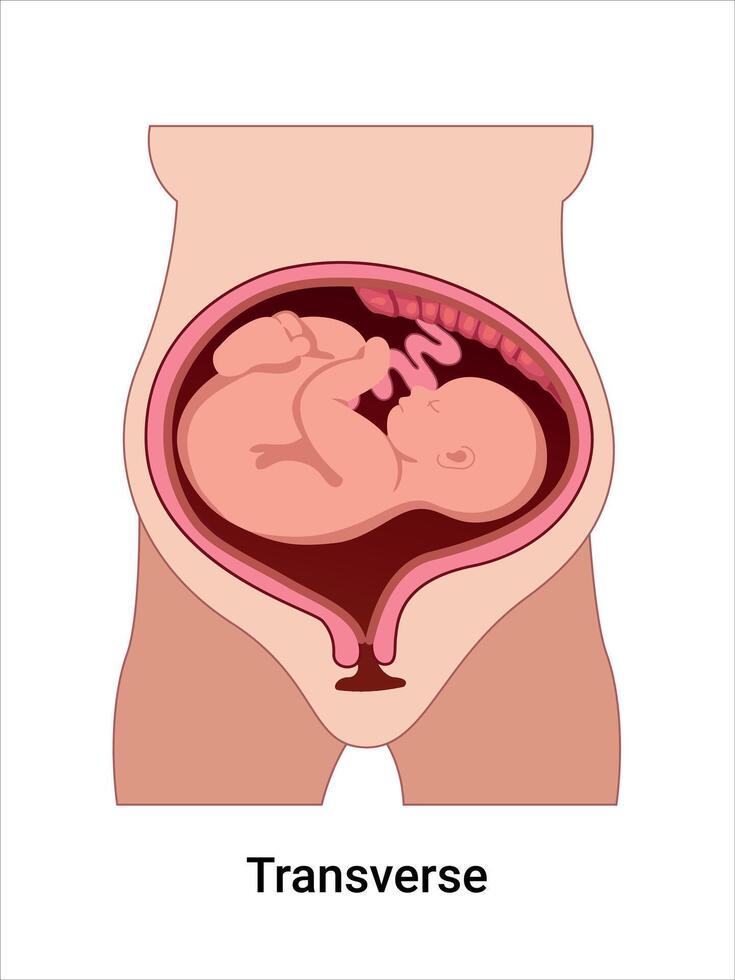 Baby in transverse position inside uterus vector