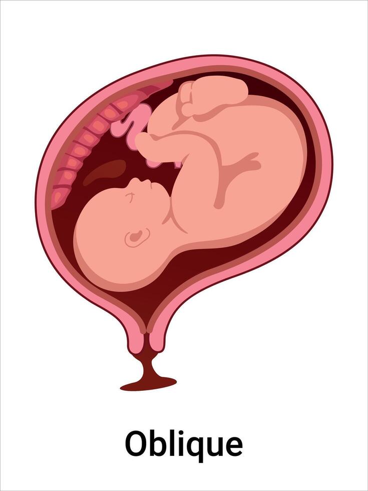 Oblique fetal position in uterine diagram vector