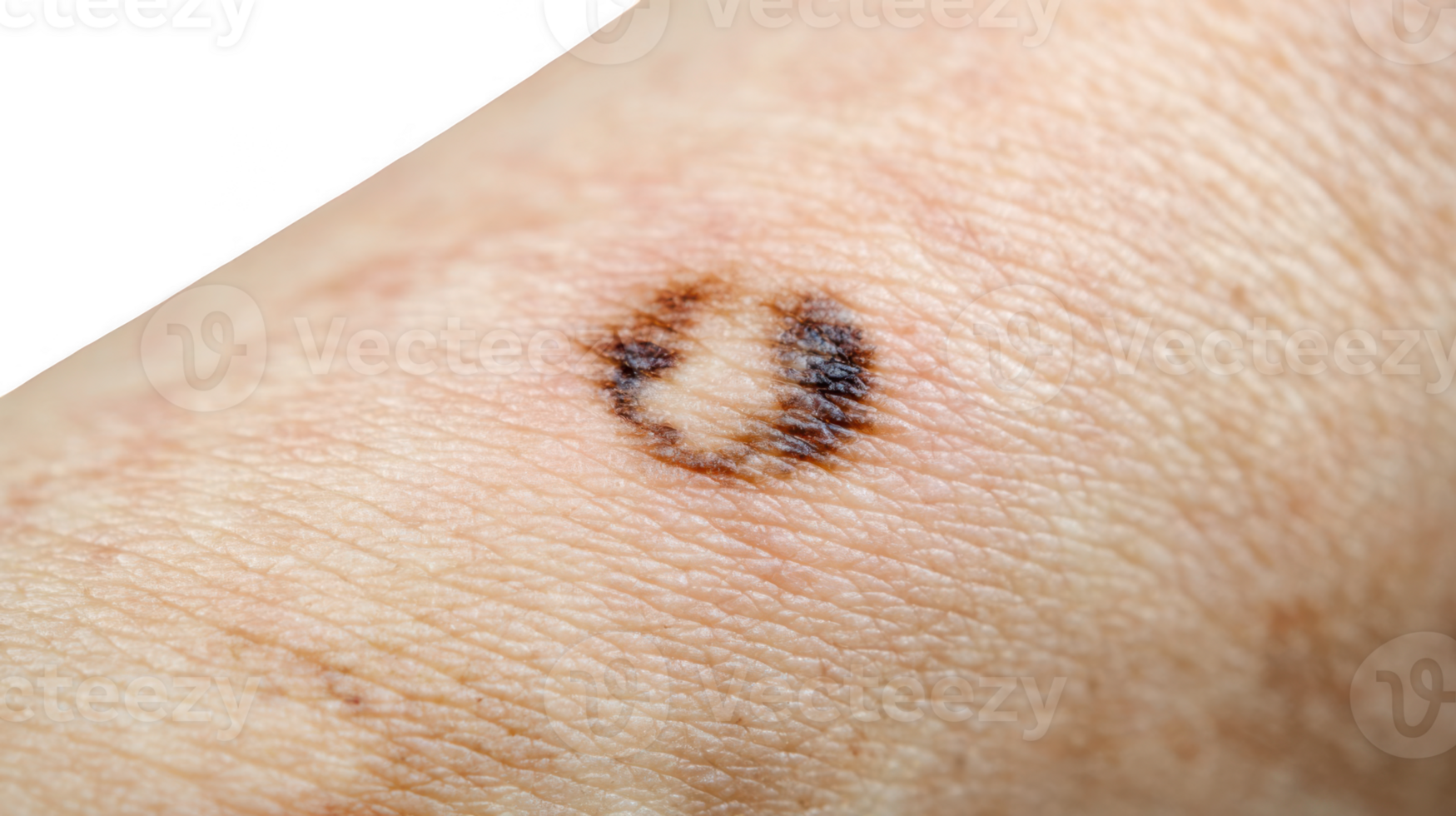 Closeup of birthmark showing skin pigmentation changes on transparent background png