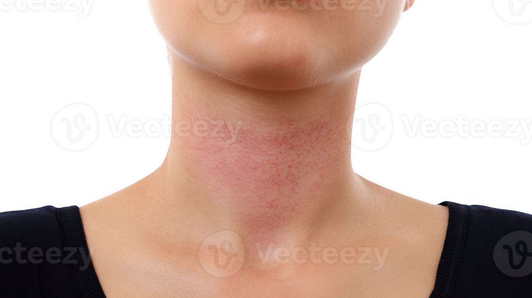 Woman showing red irritated skin rash on neck on transparent background png