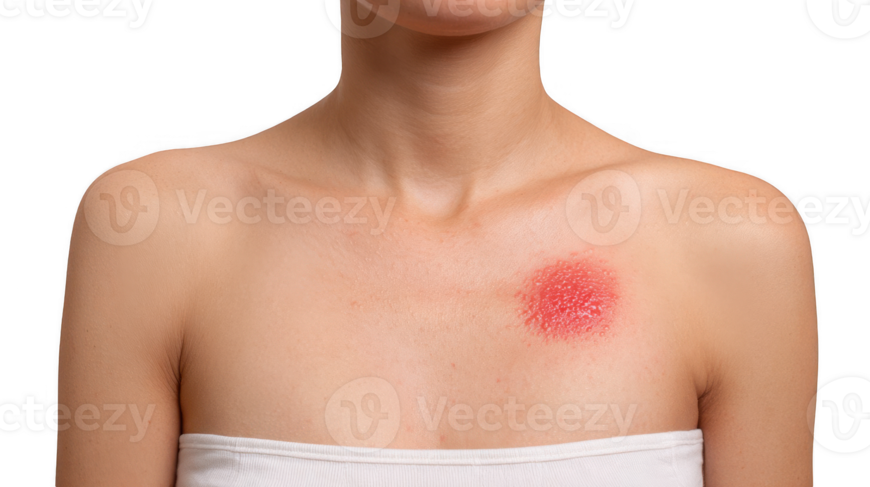 Woman showing red sunburned skin patch on chest on transparent background png