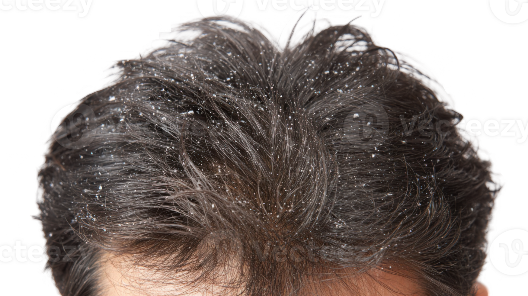Close up of dandruff flakes on dark hair with transparent background png