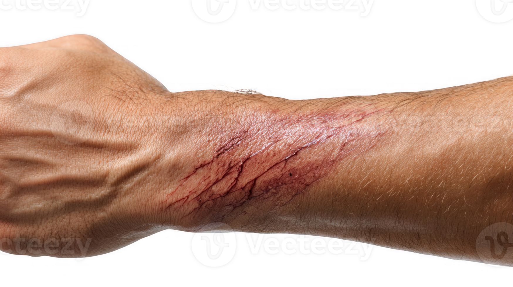 Close up of deep scratches bleeding on man's arm with transparent background png