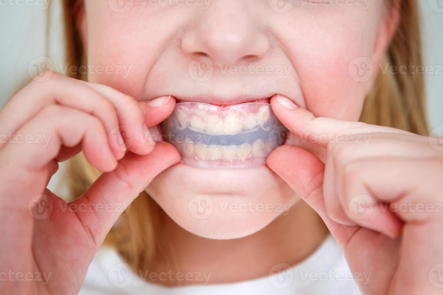 Dental simulator for teeth alignm.ent . The child has mouth guards on his teeth. photo