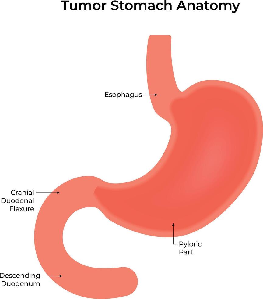 Stomach Tumor Anatomy Science Design vector