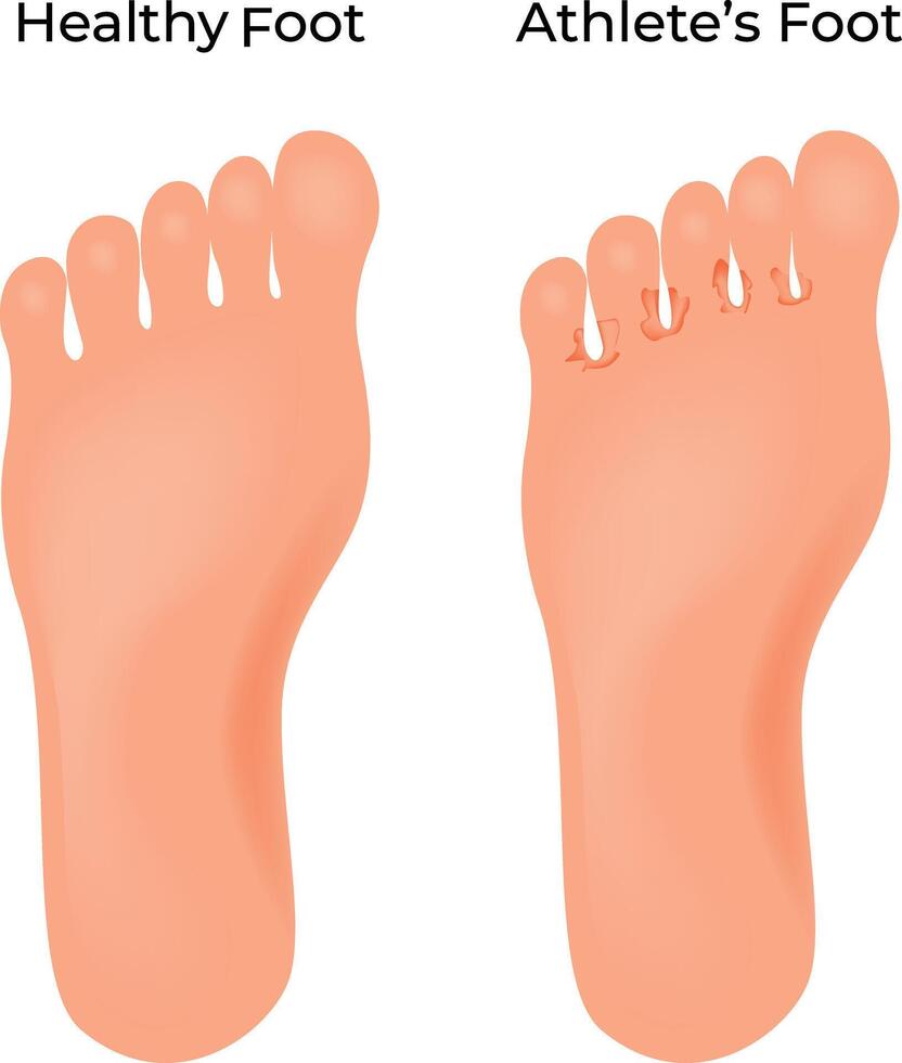 Athletes Foot vs Healthy Foot Illustration vector
