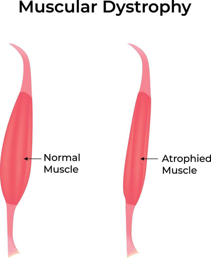 Muscular Dystrophy Normal vs Atrophied Muscle vector