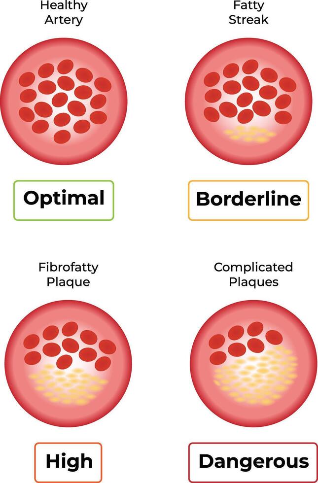 Progression of Artery Health From Optimal to Dangerous Conditions Illustration vector