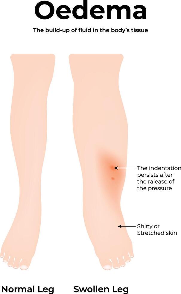 Oedema in the Leg Science Design Illustration Diagram vector