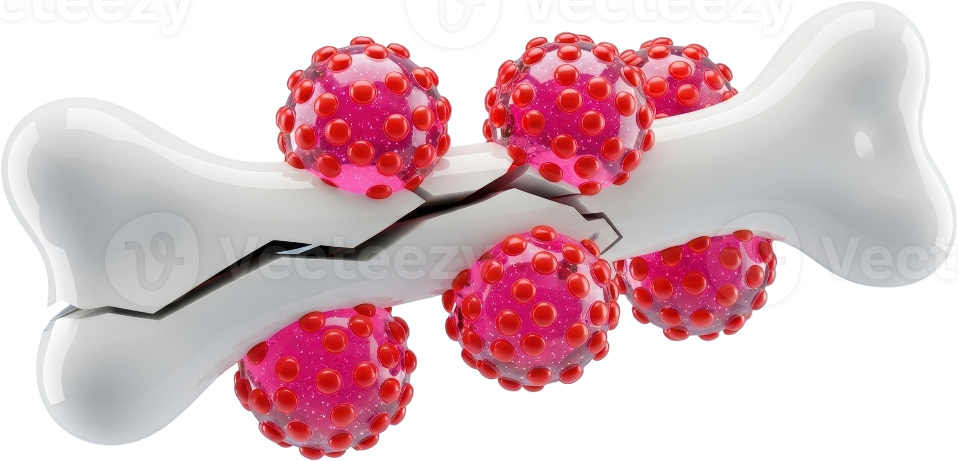 Fractured bone structure with invasive pink cells, medical illustration of disease png