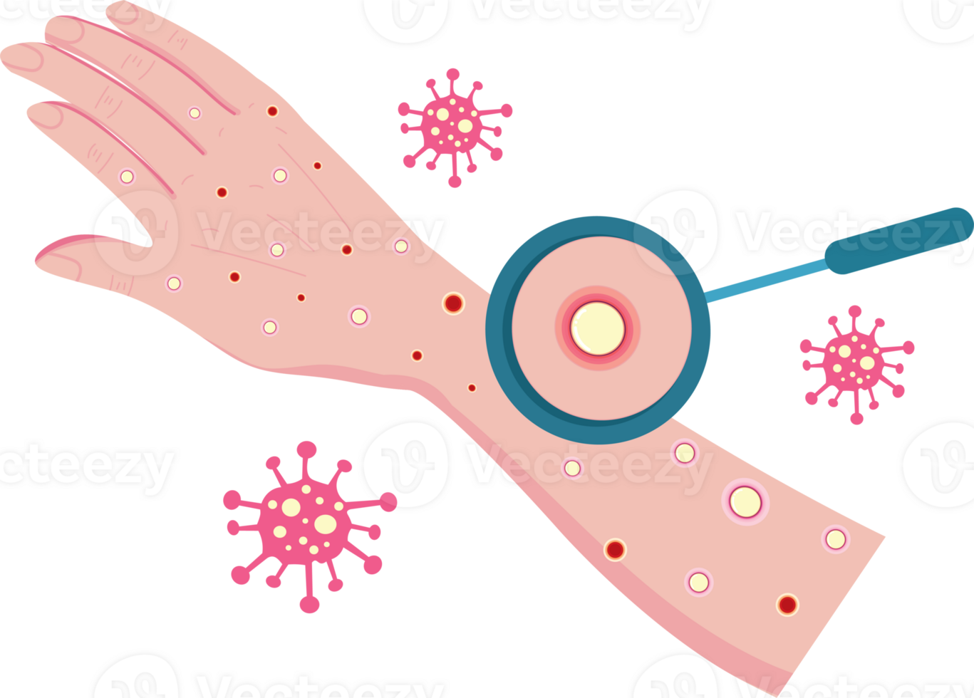 Monkeypox Alert with Infected Skin Condition png