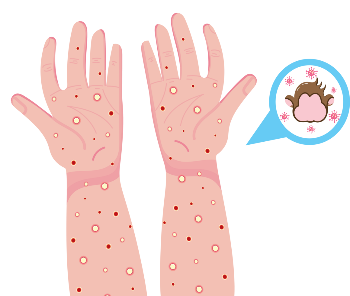 Health Warning About Monkeypox Disease png