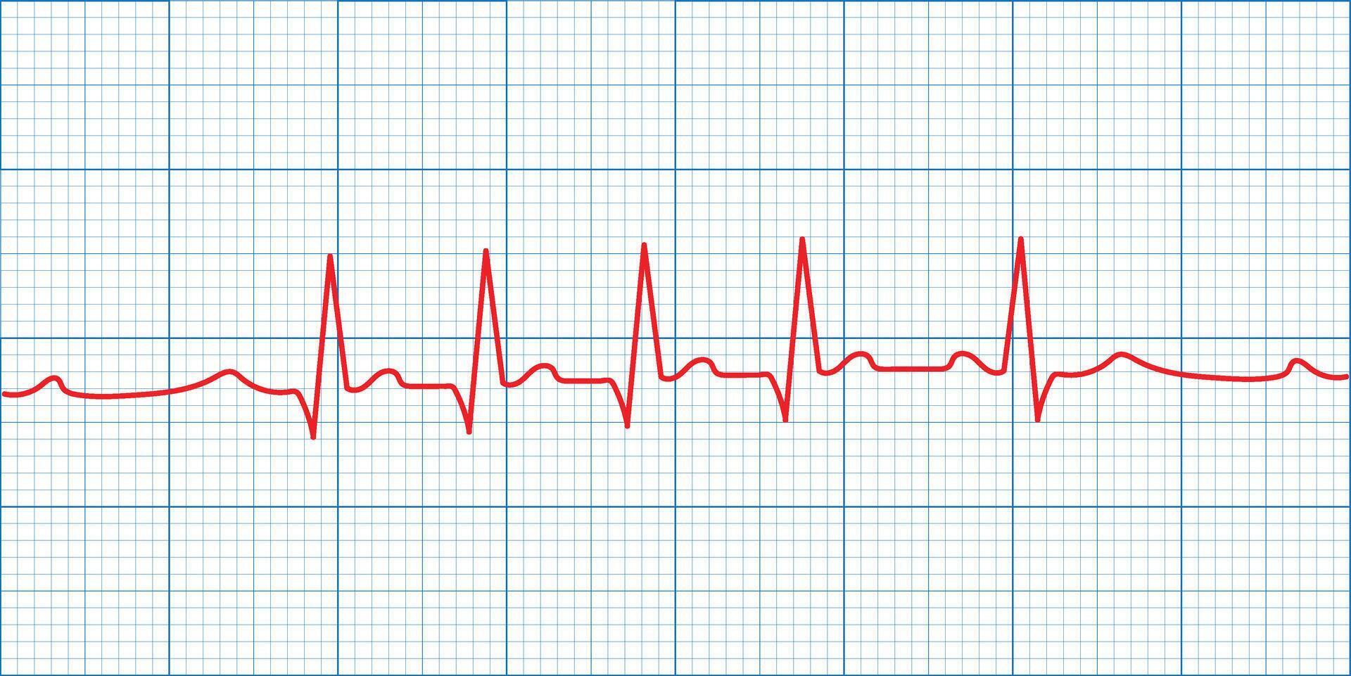 Medical heart rate monitoring displayed on an ECG or EKG graph with a clear pulse line. vector