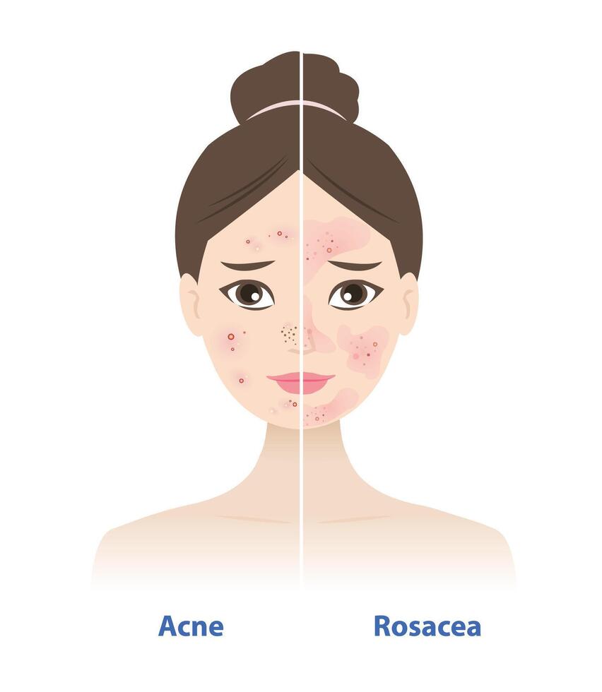 Comparison of acne and rosacea on woman face illustration. The different types of acne, redness around breakout only. Rosacea, cause redness on cheeks, nose, chin, forehead, sometimes pimples. vector
